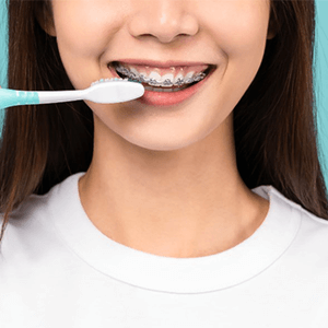 Fogszabályzód van? Így ápold a fogaidat.